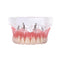 Restauración de modelo de implante de dientes de sobredentadura dental