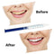 Teeth Whitening Dental Bleaching System Oral Gel Kit Tooth Whitener + 10 pcs C-SHAPE Adult Teeth Whitening Intraoral Cheek Lip Retractor Mouth Opener