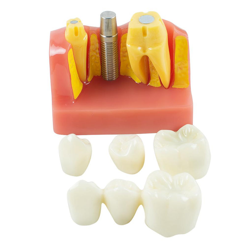 Advanced dental research model with removable tooth model for implant analysis demonstration
