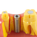 Advanced dental research model with removable tooth model for implant analysis demonstration