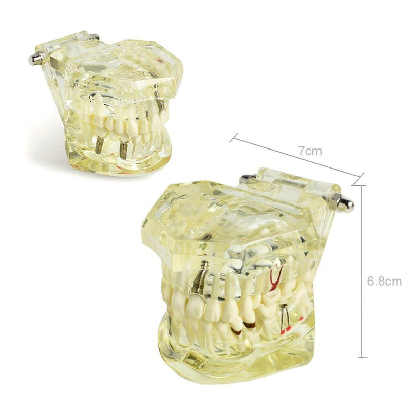 Dental Implant Disease Teeth Model with Restoration & Bridge Tooth Model Demonstration With Removable Tooth