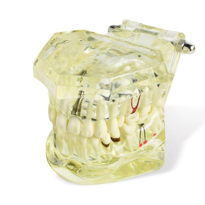 1pc Zahnimplantat Krankheitszahnmodell mit Restaurierung und Brückenzahn