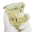 1 st Tandimplantaat Ziekte Tanden Model met Restauratie & Brugtand