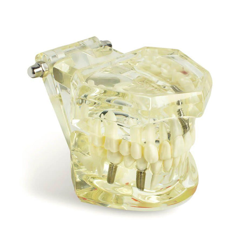 1pc Denti per malattie da impianto dentale Modello con restauro e dente a ponte