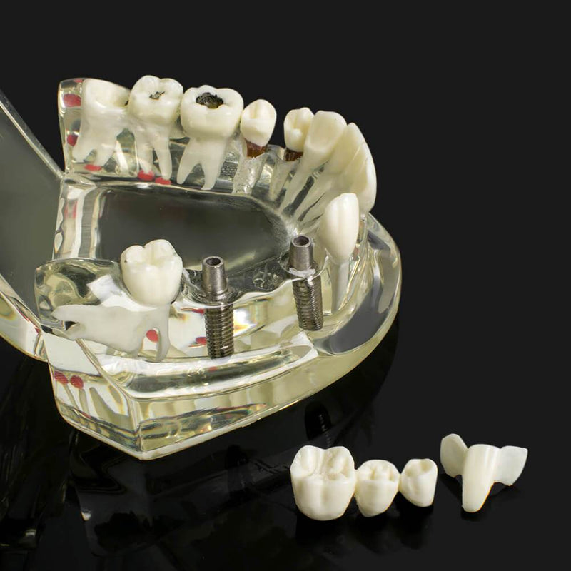1 modèle de dents de maladie d'implant dentaire avec restauration et dent de pont
