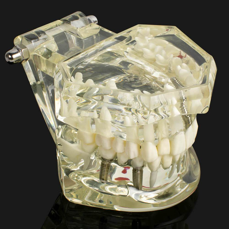 1 modelo de dientes de enfermedad de implante Dental con restauración y diente de puente