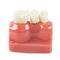 Démonstration dentaire Modèle de dents Analyse d'implant Couronne Bridge