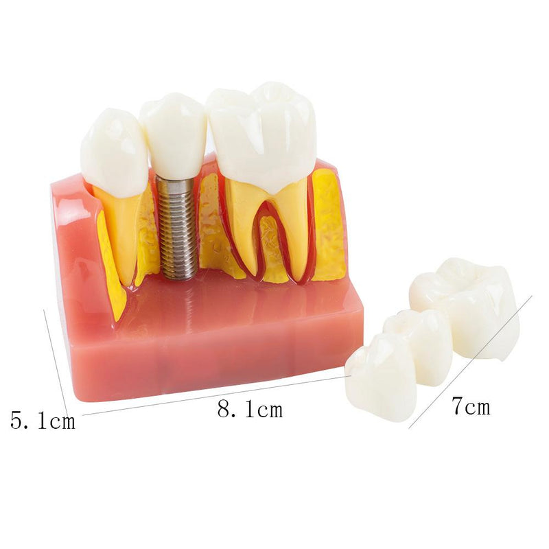 Dental Demonstration Zahnmodell Implantatanalyse Kronenbrücke
