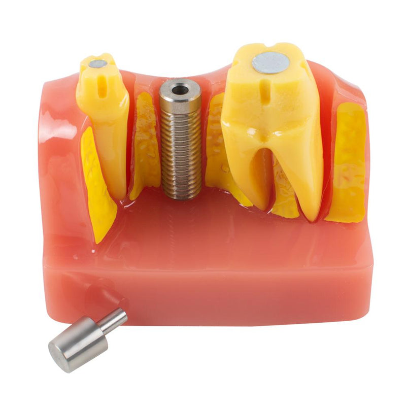 Demostración dental Modelo de dientes Análisis de implante Puente de corona