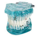 Modèle de dents pathologiques adultes transparentes de dent d'étude dentaire