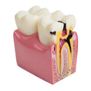 Modello di educazione dei denti del paziente odontoiatrico Modello di studio di confronto della carie 6 volte