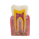 Modello di educazione dei denti del paziente odontoiatrico Modello di studio di confronto della carie 6 volte