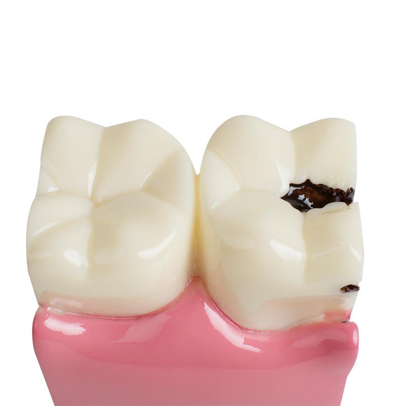 Modelo de dientes de educación de pacientes dentales 6 veces modelo de estudio de comparación de caries