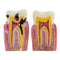 Modèle de dents d'éducation des patients dentaires modèle d'étude de comparaison de caries 6 fois