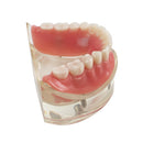 Étude de restauration d'implants inférieurs à 2 prothèses dentaires sur modèle dentaire