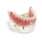 Modelo Dental Sobredentadura Inferior 2 Implantes Estudio de Restauración