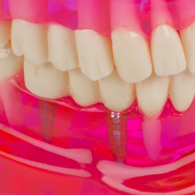 Tandheelkundige tanden Model Leren studeren Orale implantaatrestauratie en pathologie