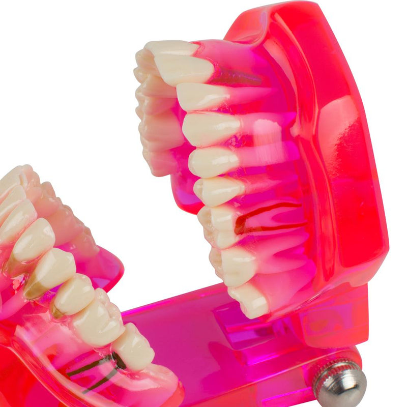 Tandheelkundige tanden Model Leren studeren Orale implantaatrestauratie en pathologie
