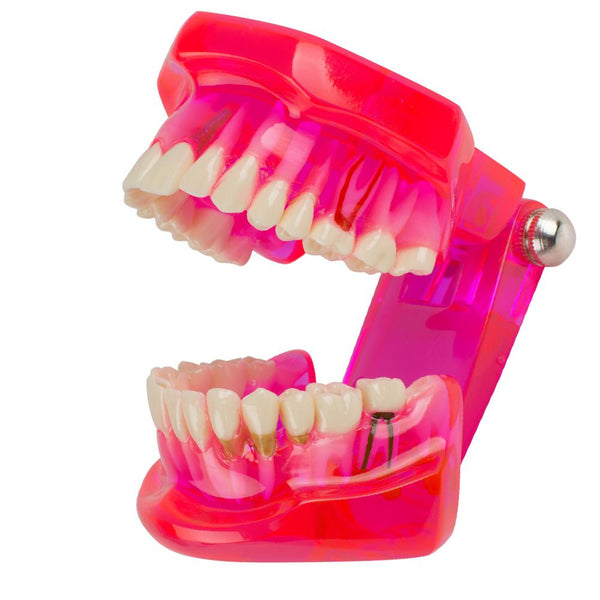 Modèle de dents dentaires Enseignement de l'étude Restauration et pathologie des implants buccaux