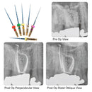 10Packs/60PCS Dental Endodontic Endo Memory Engine Rotary Root Canal NiTi File 25mm files