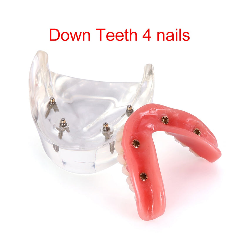 Tandheelkundige overkappingsprothese Tanden implantaatmodel Restauratie
