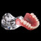 Ricostruzione del modello implantare di denti overdenture dentali