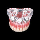 Restauración de modelo de implante de dientes de sobredentadura dental