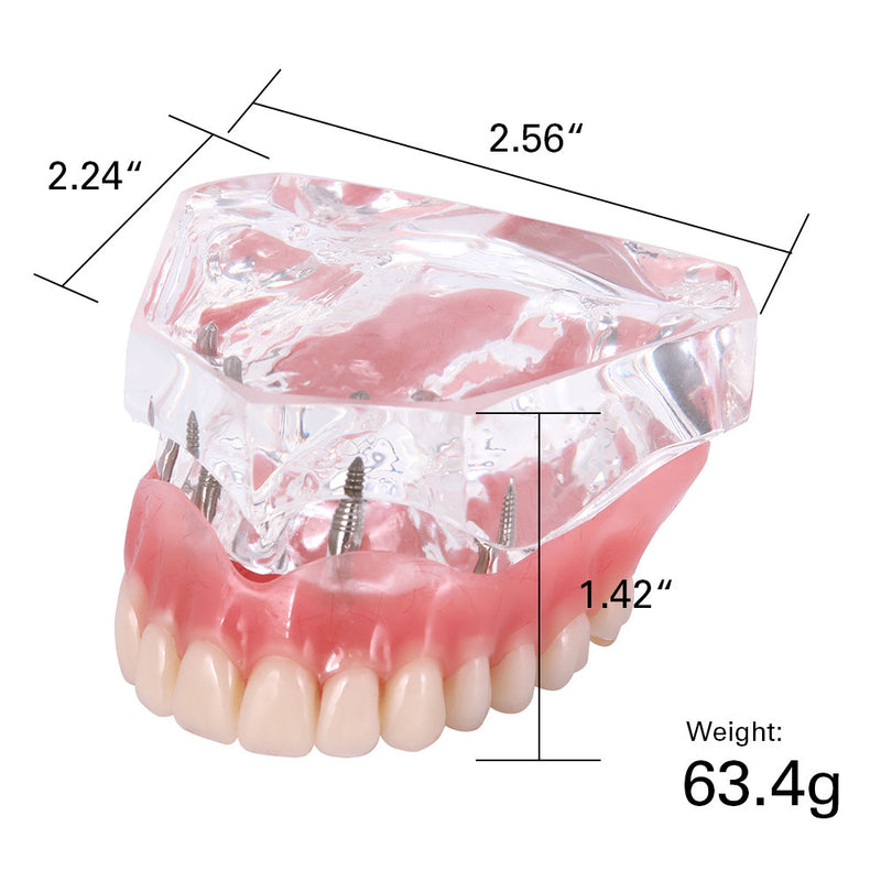 Ricostruzione del modello implantare di denti overdenture dentali