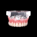 Restauration de modèle d'implant de dents de prothèse dentaire