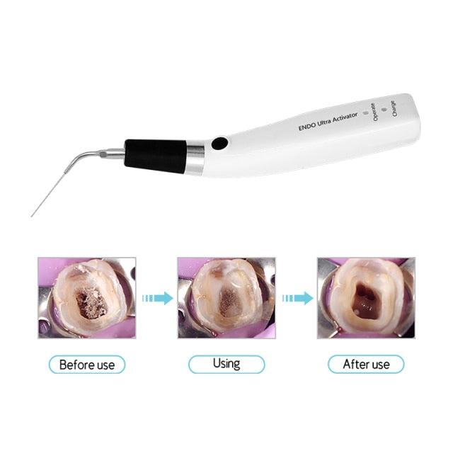 Opération ultrasonique sans fil dentaire Endo Activateur ultrasonique